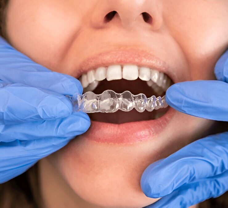 Invisalign Consultation at Ross Creek Dental in Fort Saskatchewan
