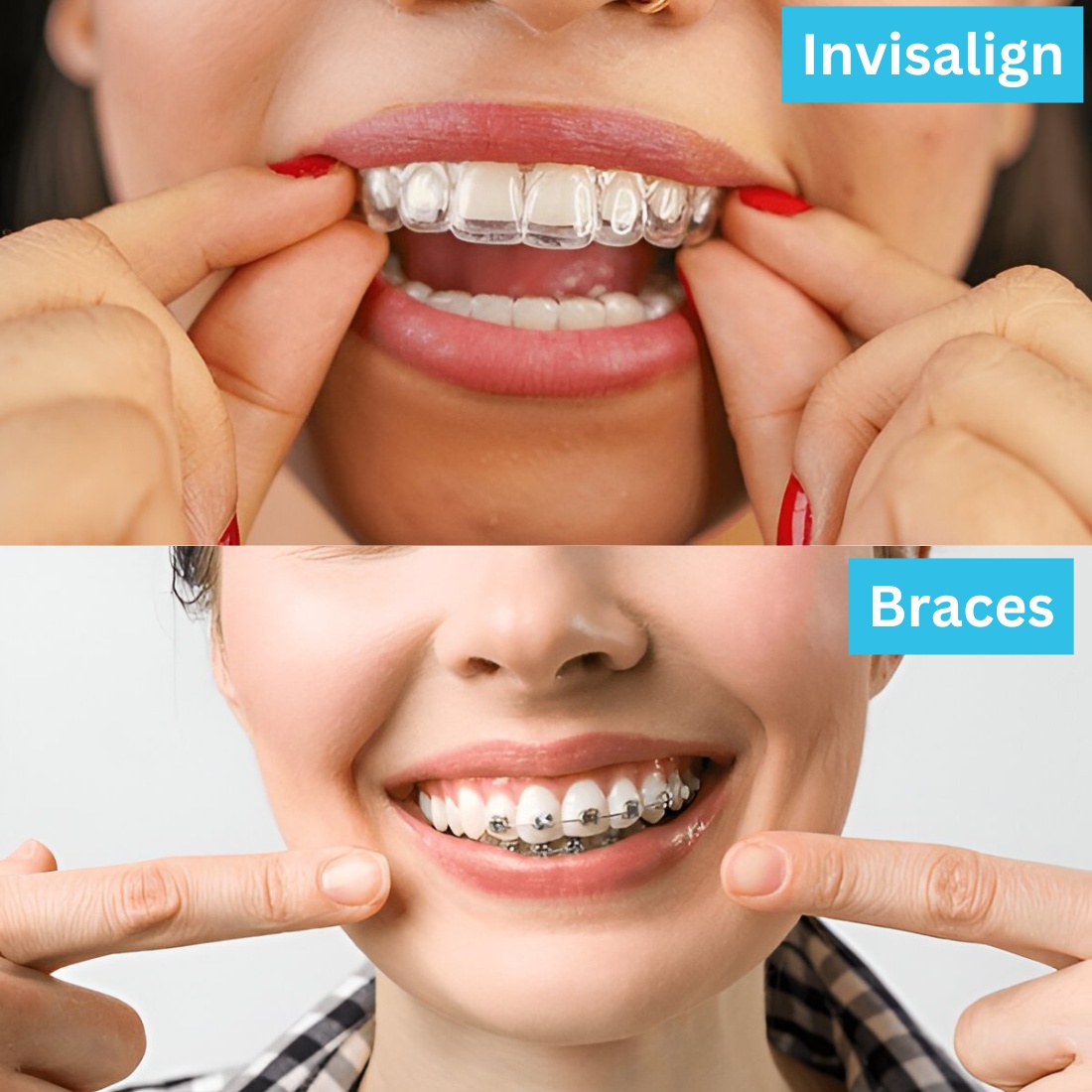 Invisalign vs. Braces