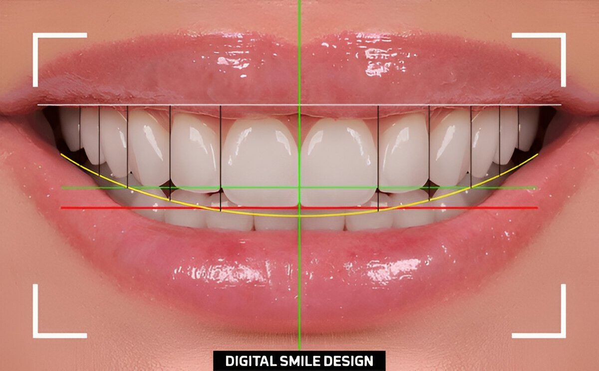 Personalized Smile Design
