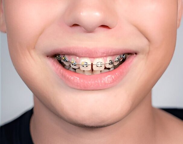 Children Orthodontics Fort Saskatchewan