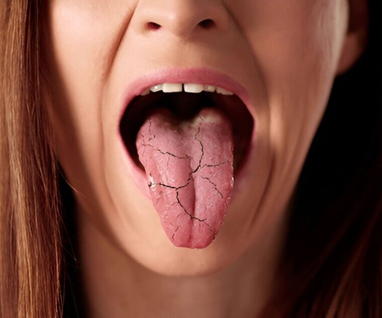 Dry Mouth Treatment